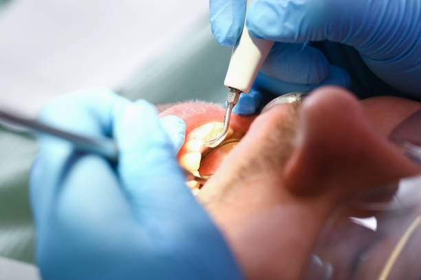 Best Emergency Dentist for Knocked-Out Tooth in Anderson, IN