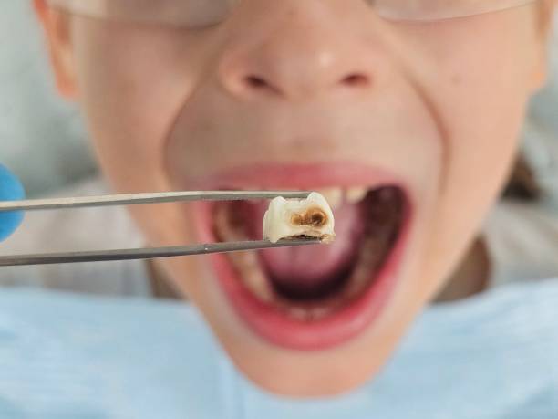 Best Emergency Root Canal Treatment in Anderson, IN
